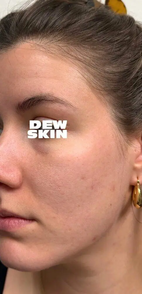 Active acne clearing after