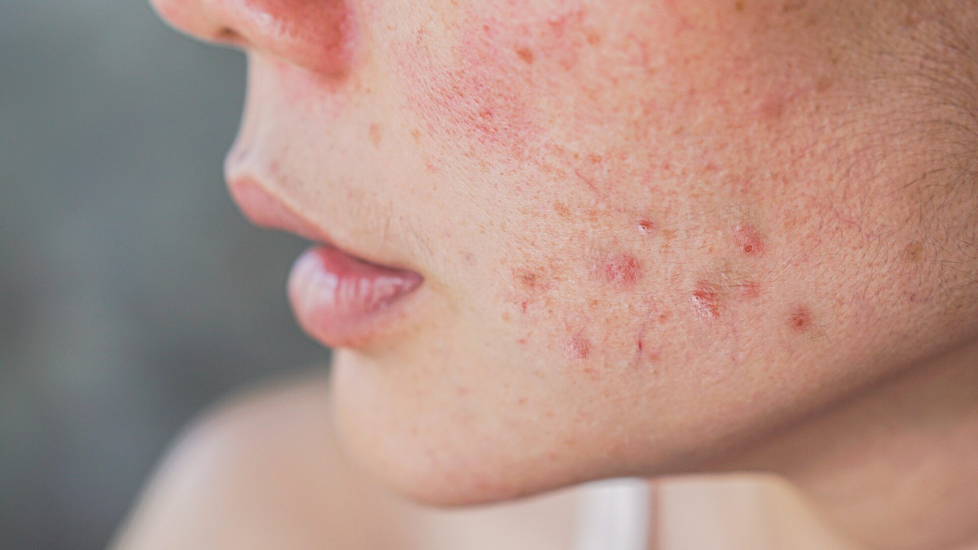 #ClearSkinEra · Active Acne