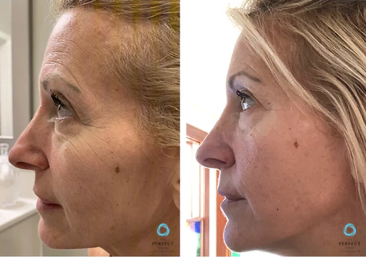 Pro Clinical Peel by Perfect Derma™ before and after