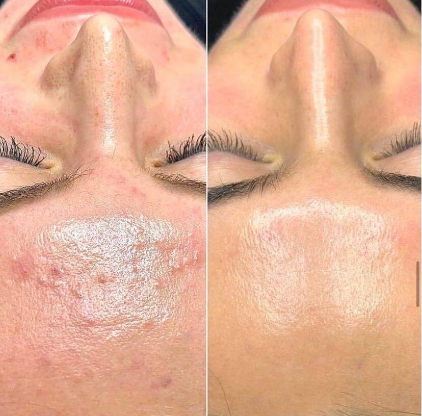 Dewskin laser facial before and after result 1