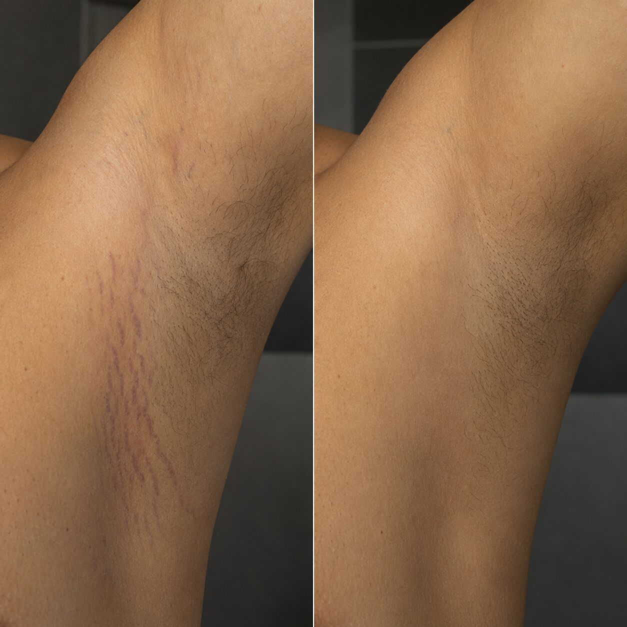 Stretch mark treatment before and after 3