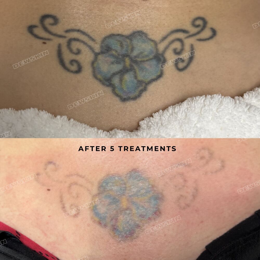 Tattoo removal before and after 2